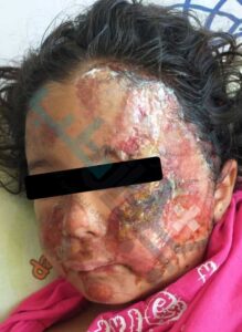  دختر بچه 5 ساله در اثر تصادف و کشیده شدن پوست صورت روی آسفالت قبل از استفاده از پماد کلس